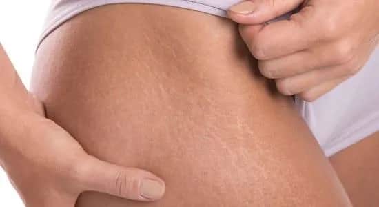 Czy skóra się rozciąga? Poznaj przyczyny i skutki elastyczności skóry